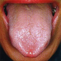 Zungenbelag brauner Zungenbelag: verhindern